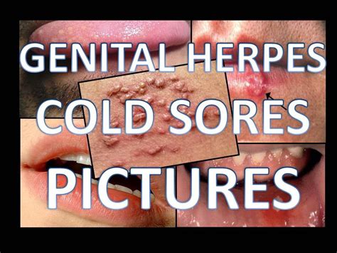 vaginal herpes pictures